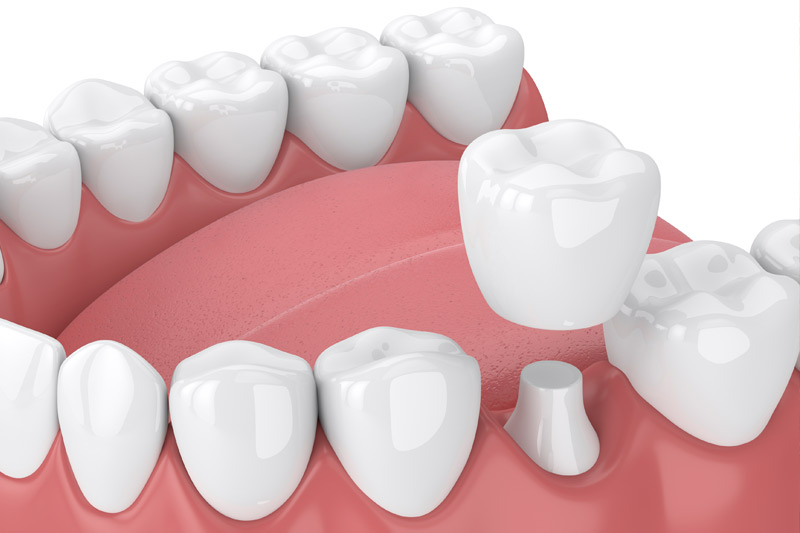 Dental Crowns in Pacoima