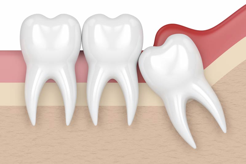 Wisdom Tooth Removal in Pacoima